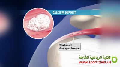 التهاب الأوتار التكلسى في الكتف - Shoulder calcification