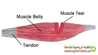 التمزق العضلي (Rupture) - الأسباب - الأعراض - العلاج