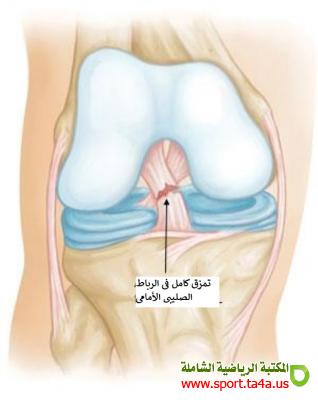 إصابة الرباط التصالبي الأمامي ACL Anterior cruciate ligament
